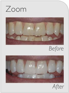 Before/after zoom whitening