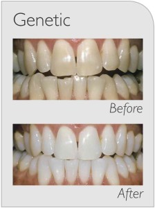 before /after teeth whitening