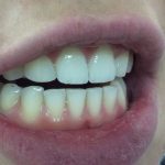 MY Post-composites and whitening 4