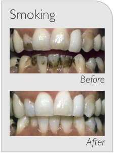 before/after teeth whitening