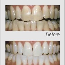 before /after teeth whitening