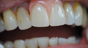 during image of denture placement