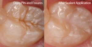 before/after fissure seals