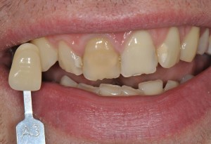 Before veneers - colour selection