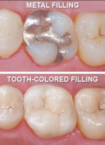 before/after tooth coloured fillings
